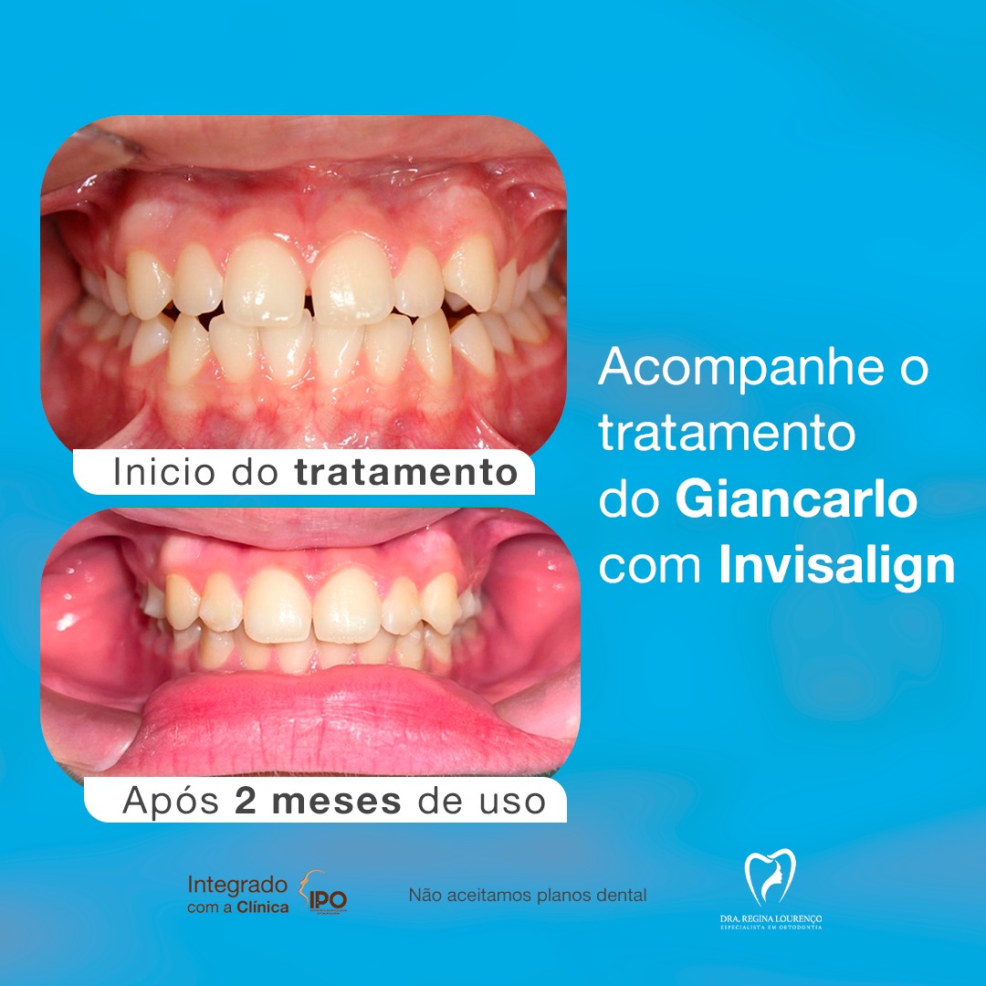 Sorriso transformado com Invisalign